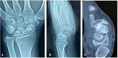 Clinical outcomes of double-screw fixation with bone grafting for displaced scaphoid nonunions: A series of 21 cases